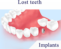 Lost teeth Implants