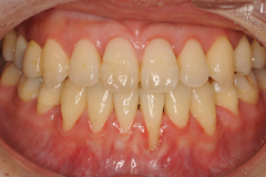 歯肉退縮に対する結合組織移植 術前