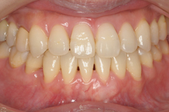 歯肉退縮に対する結合組織移植 術後